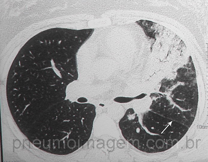FDA APROVOU NOVO TRATAMENTO INTRAVENOSO PARA INFLUENZA FDA APROVOU NOVO TRATAMENTO INTRAVENOSO PARA INFLUENZA